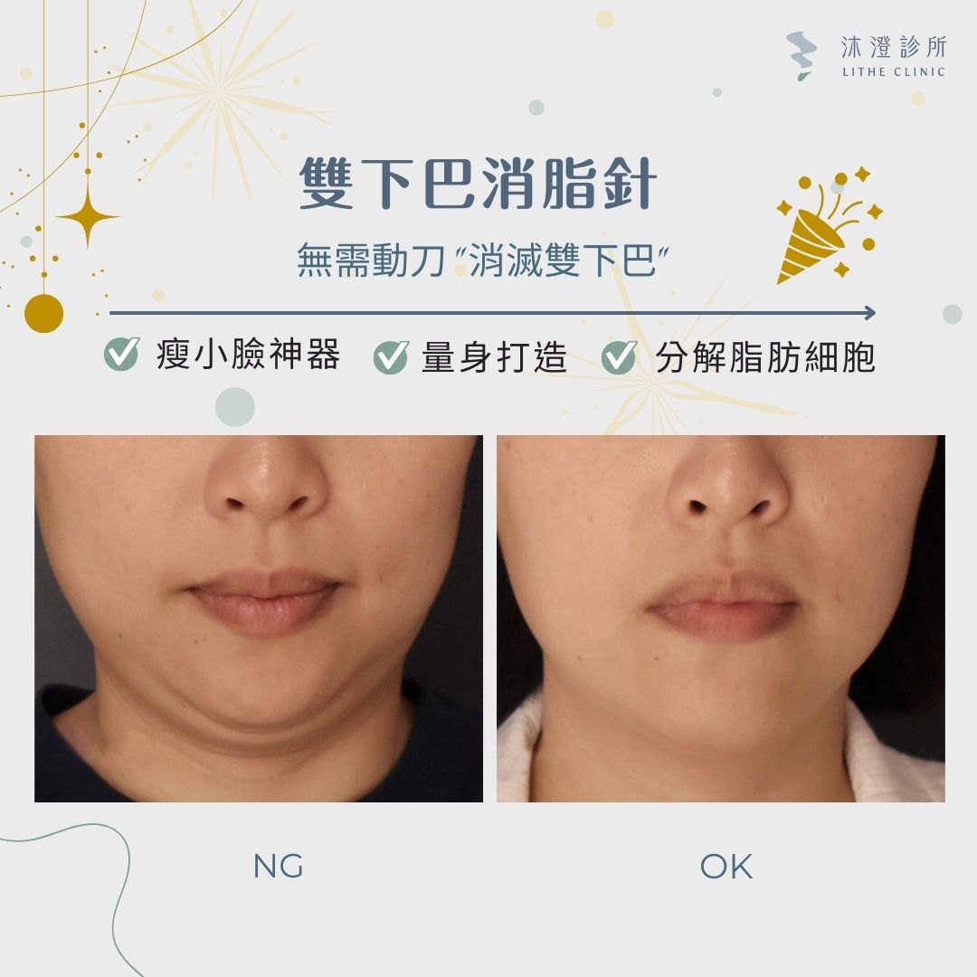 雙下巴消脂針